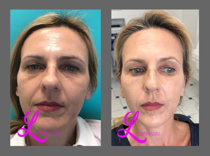 Laserska 3D rejuvenacija